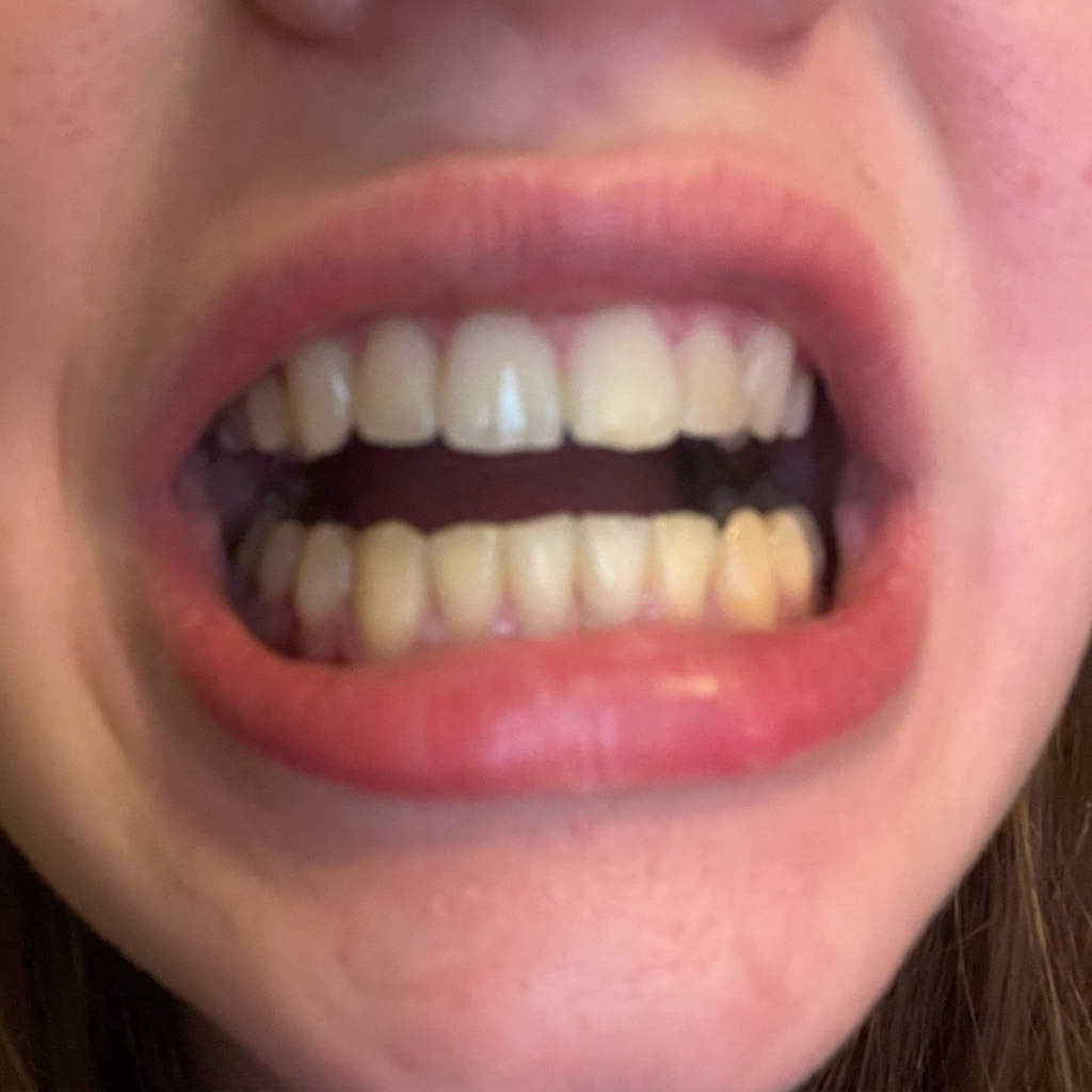 Before whitening result