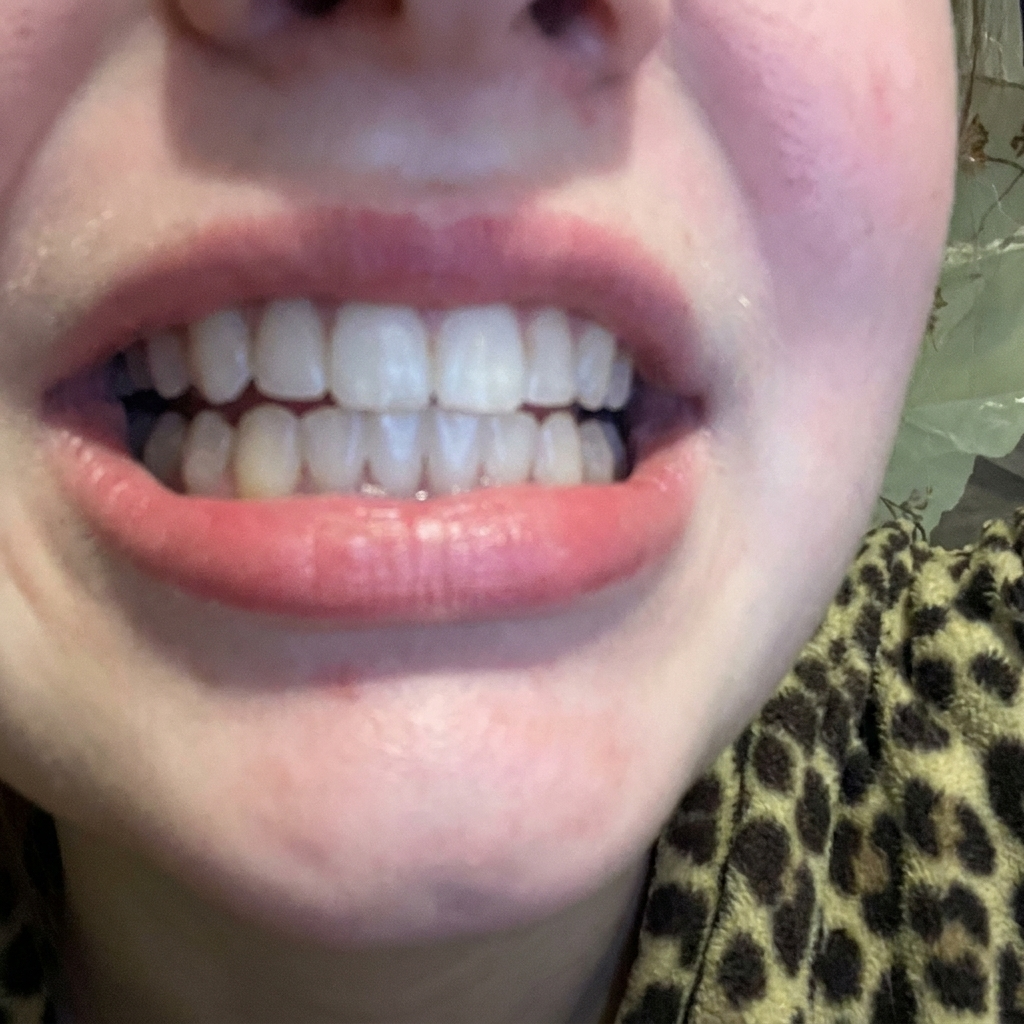 After whitening result