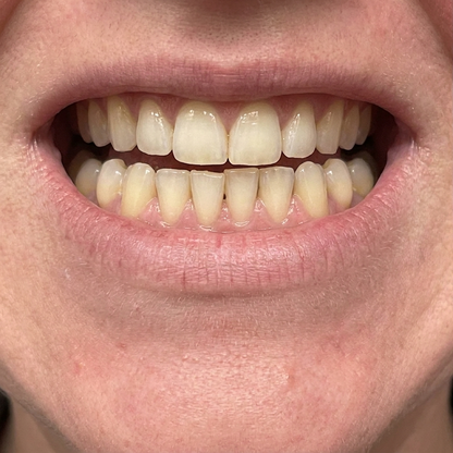 Before whitening result