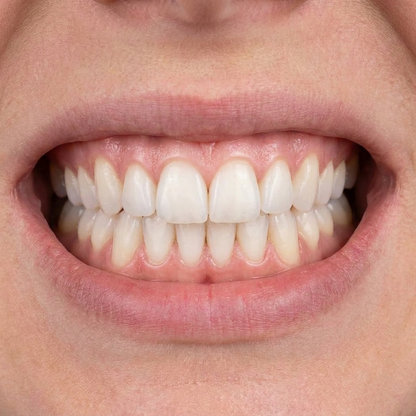 After whitening result
