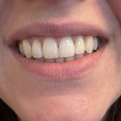Before whitening result