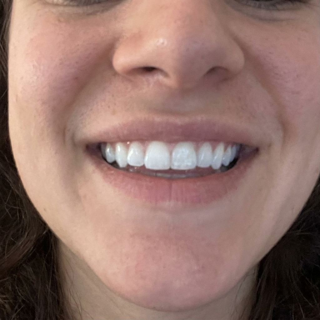 After whitening result