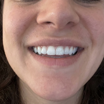 After whitening result