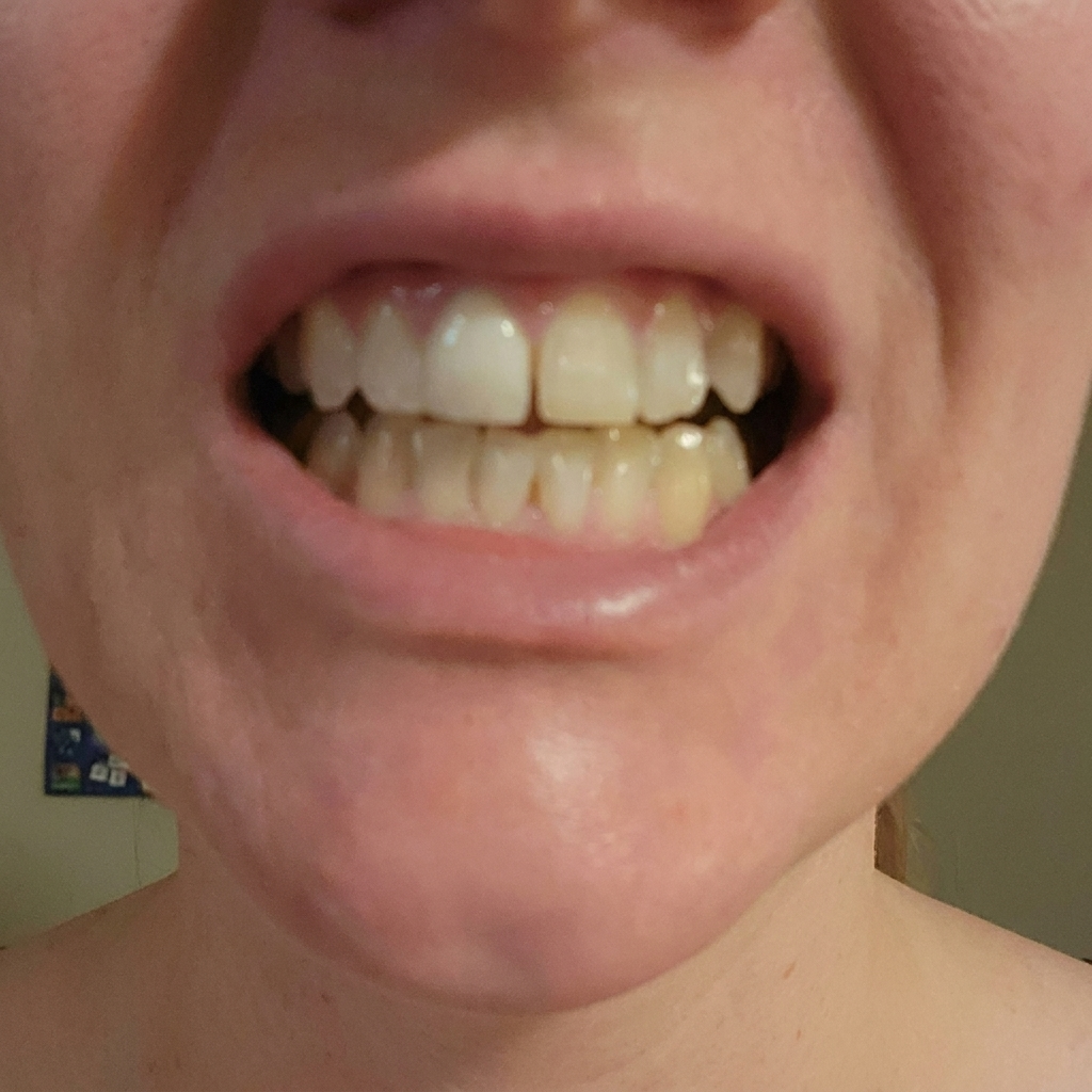 Before whitening result