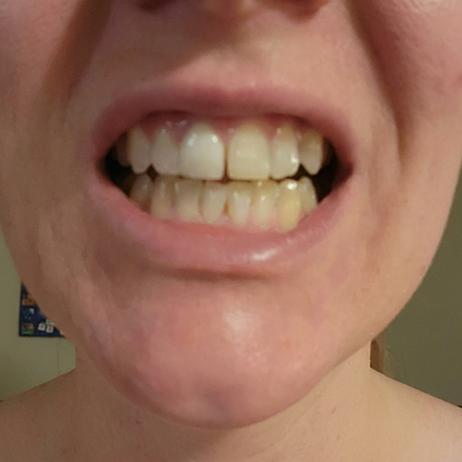 Before whitening result