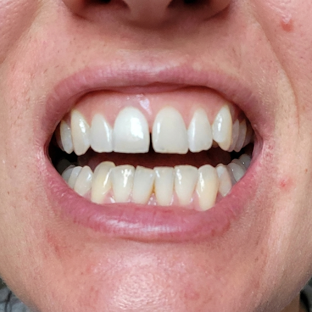 After whitening result